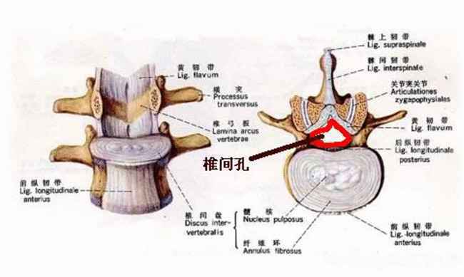 椎间孔狭窄